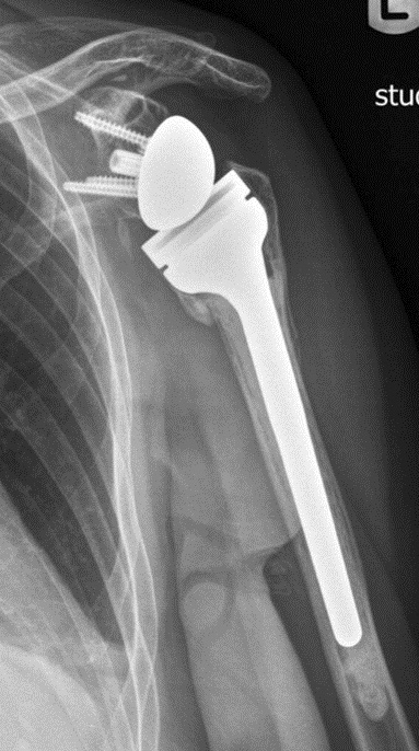 shoulder replacement