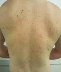 Pityriasis Rosea