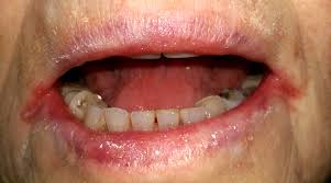 Cheilitis