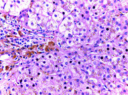 Hemochromatosis