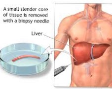 Liver Biopsy