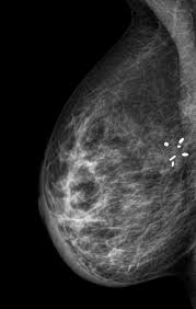 Mammogram