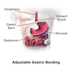 Laparoscopic