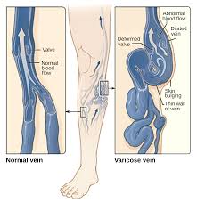 Varicose vein removal