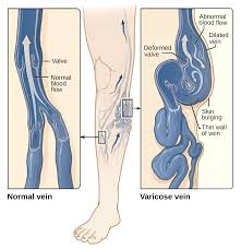 Varicose vein removal