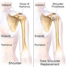 Total Shoulder Replacement Surgery