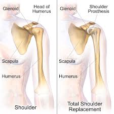 Total Shoulder Replacement Surgery