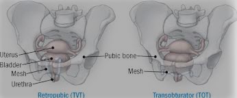 Mid Urethral Sling Surgery