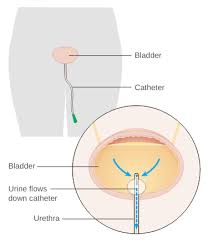 Going Home With A Urinary Catheter