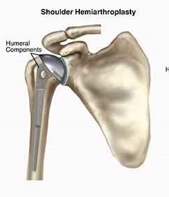  Partial Shoulder Replacement