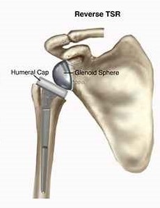  Reverse Total Shoulder Replacement Surgery