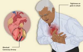 Angina Pain