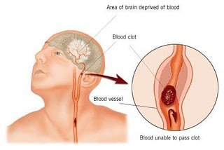 Heart Diseases And Strokes