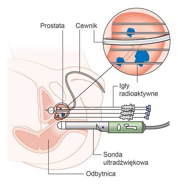 Internal Radiation Therapy