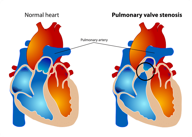 Valve Disorders