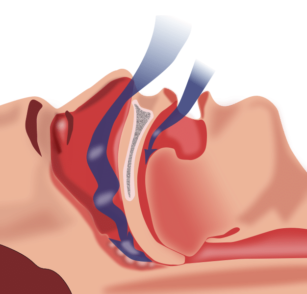 Sleep Apnea