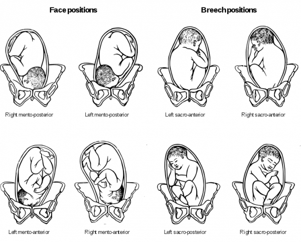 cesarean section due to breech presentation icd 10