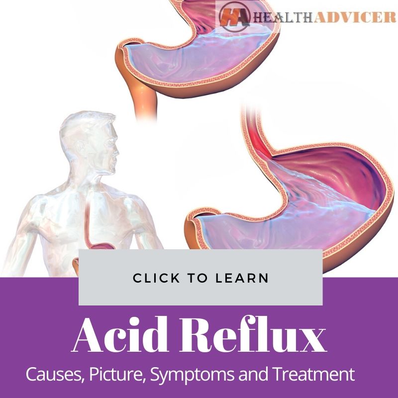 Acid Reflux: Causes, Picture, Symptoms and Treatment