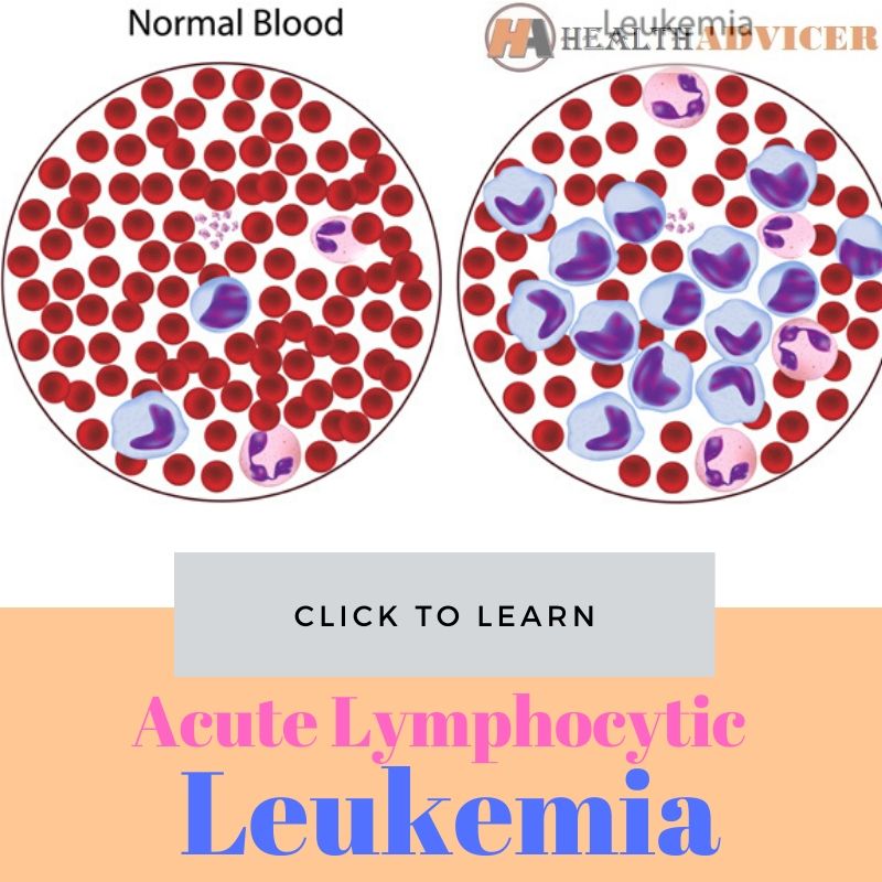 Acute Lymphocytic Leukemia