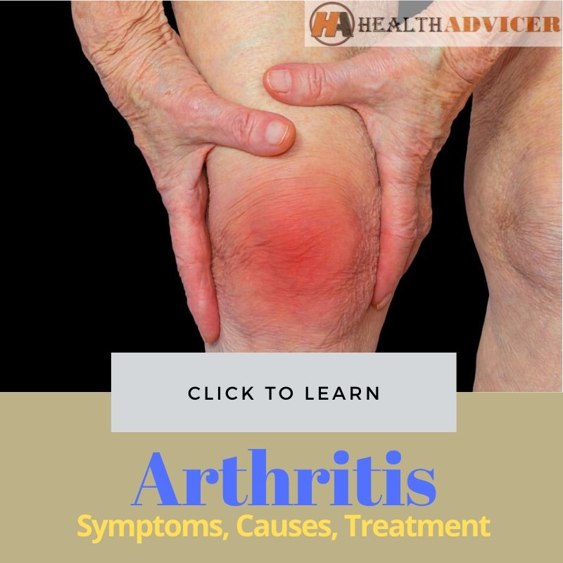 Arthritis Causes treatment picture