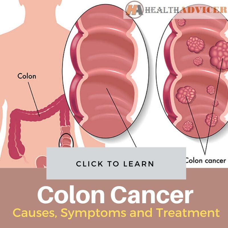 Colon Cancer Picture