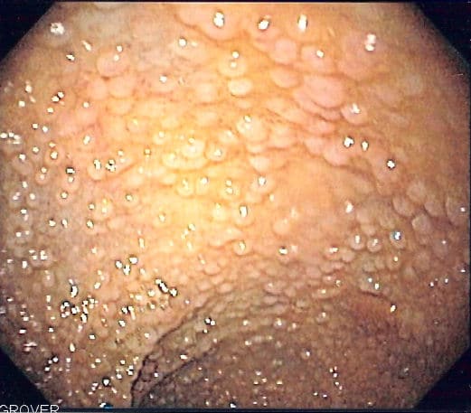 Adenomatous polyposis