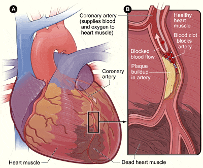 Unstable Angina