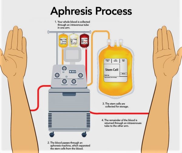 Collecting Stem Cells For Autologous Transplant