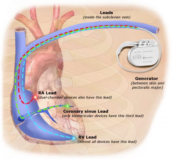 Have Pacemaker