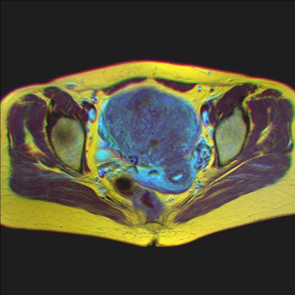 Pelvic MRI