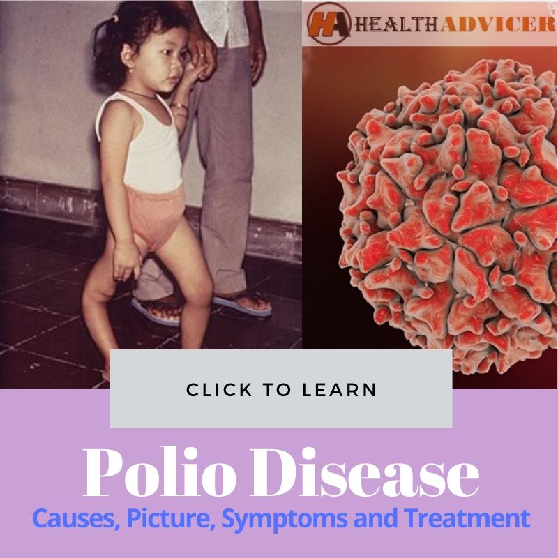 Polio Disease Picture