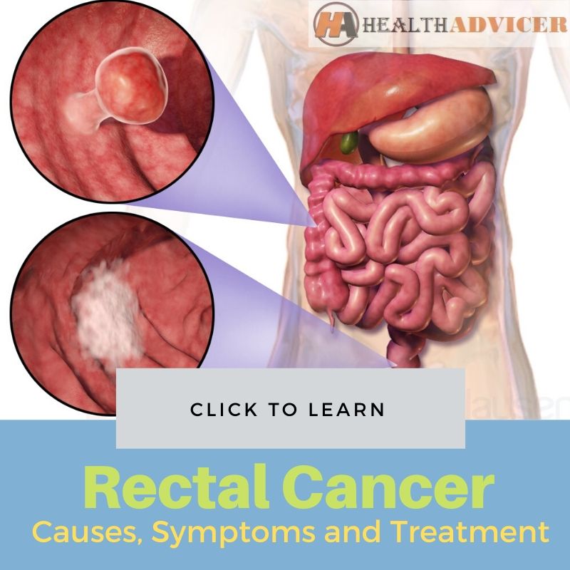 Rectal Cancer Picture