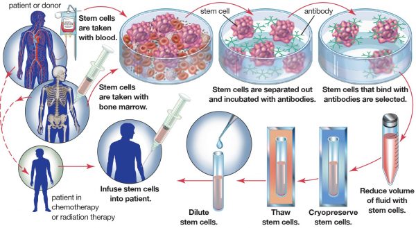 bone marrow transplant