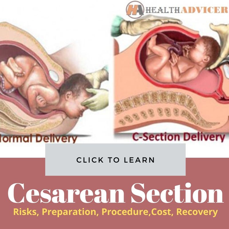 c-section-cesarean-section