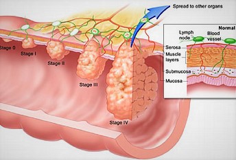 Staging Of Rectal Cancer
