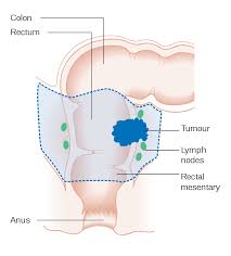 Rectal cancer