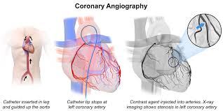 Coronary Angiography