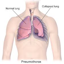 Collapsed Lung