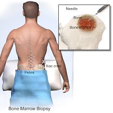 Bone Marrow Test