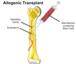 Allogeneic Transplants