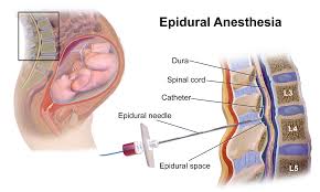 Epidural