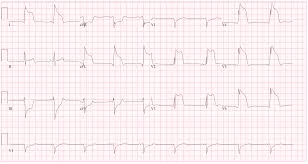 Characteristics Of Prinzmetal’s Angina Pain