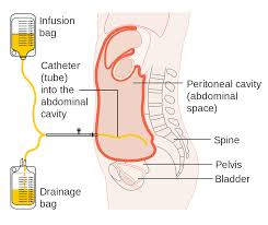 Infusions