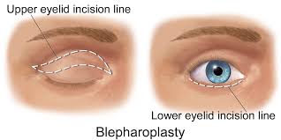 Invasive Procedure