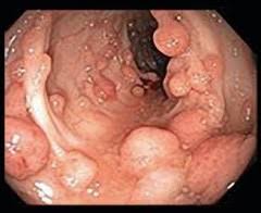 Personal History Of Polyps