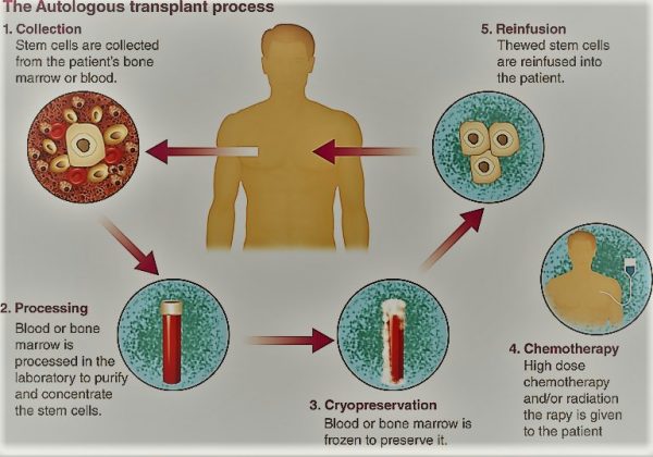 Autologous Transplants