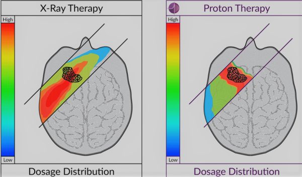 Radiation Therapy Vs Proton Therapy