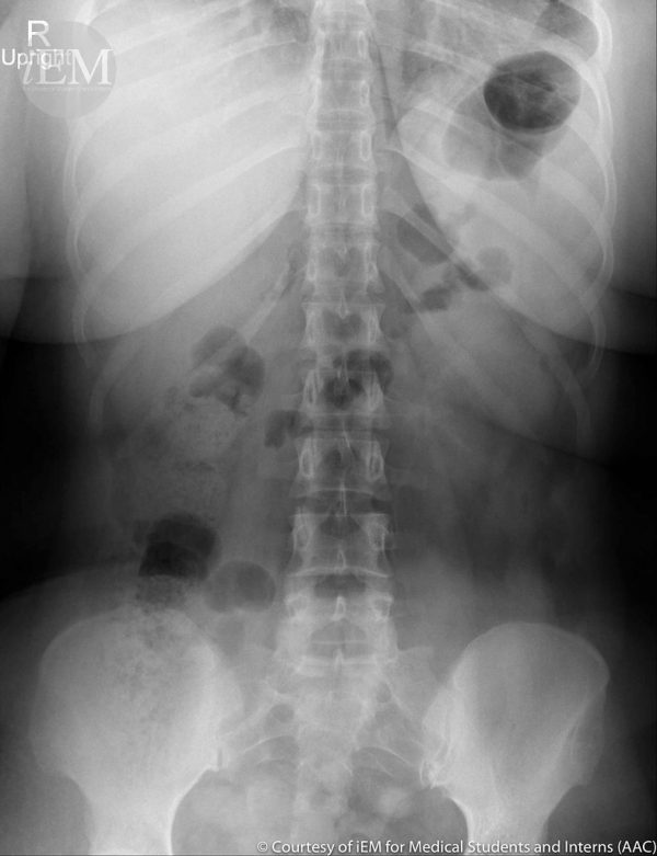 Back Pain: Causes, Symptoms, Diagnosis And Treatment