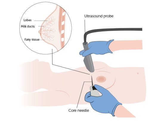 Core Needle Biopsy
