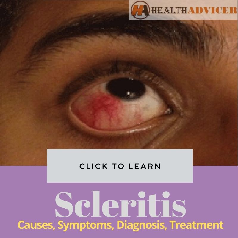 Scleritis Pictures